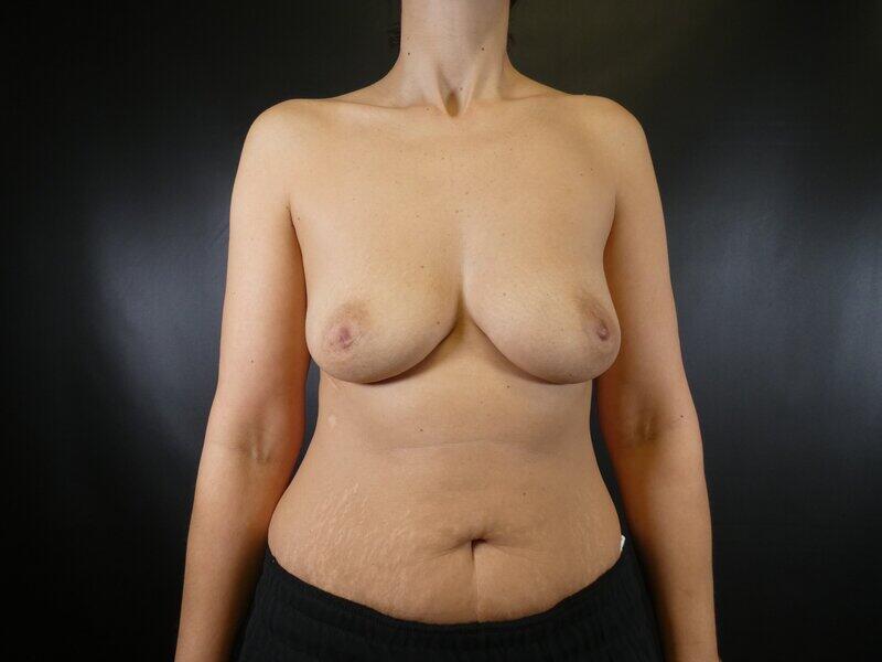 Breast Augmentation Before & After Image