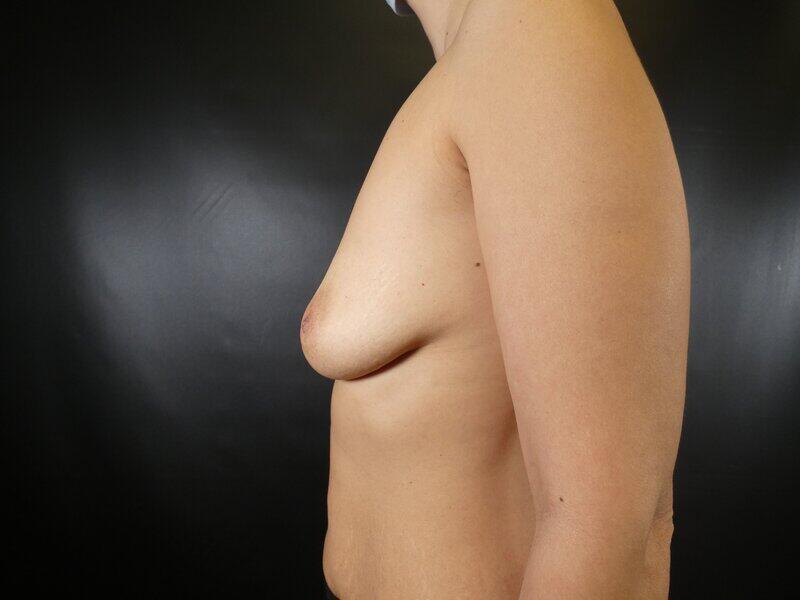 Breast Augmentation Before & After Image