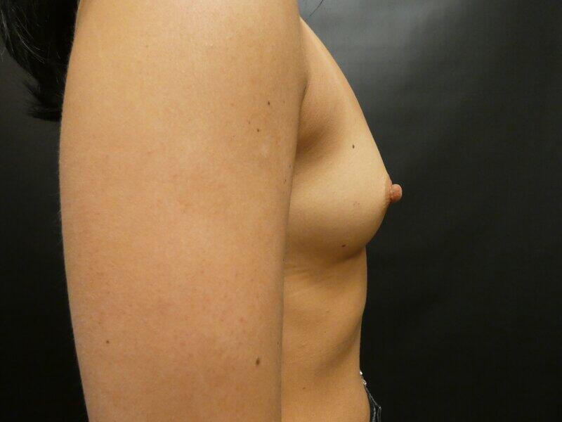 Breast Augmentation Before & After Image