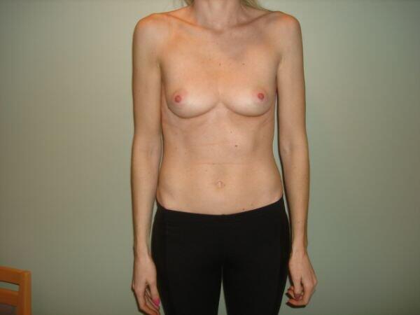 Breast Augmentation Before & After Image