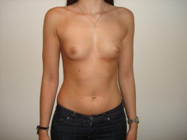 Breast Augmentation Before & After Image