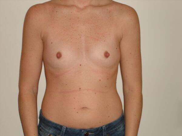 Breast Augmentation Before & After Image