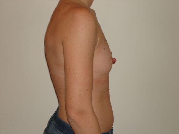 Breast Augmentation Before & After Image