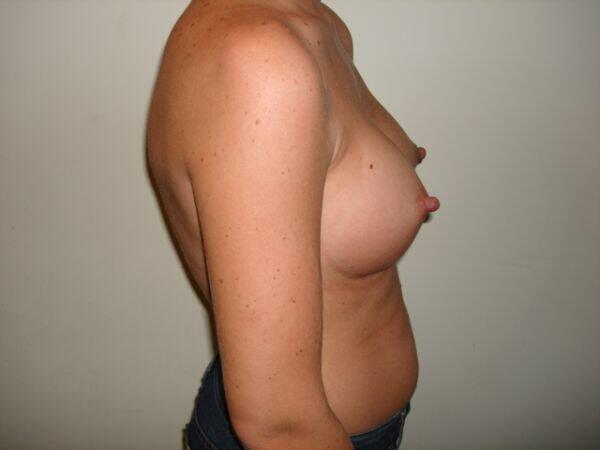 Breast Augmentation Before & After Image