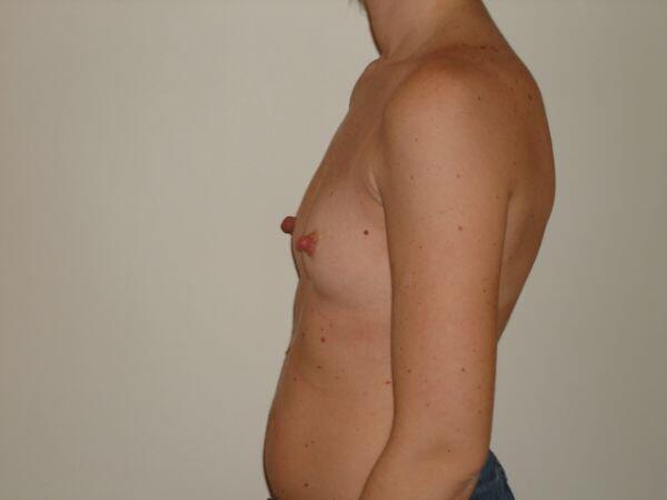 Breast Augmentation Before & After Image