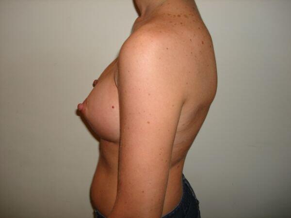 Breast Augmentation Before & After Image