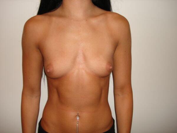 Breast Augmentation Before & After Image