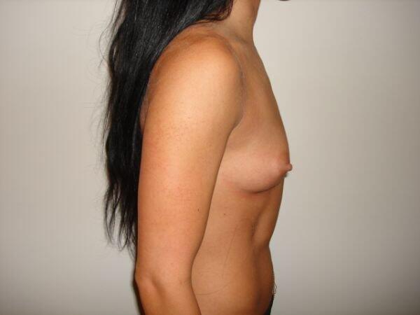 Breast Augmentation Before & After Image