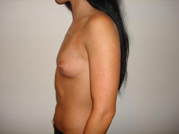 Breast Augmentation Before & After Image