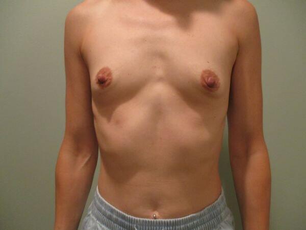 Breast Augmentation Before & After Image