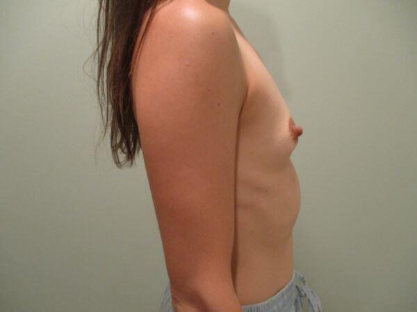 Breast Augmentation Before & After Image