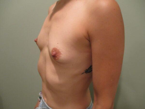 Breast Augmentation Before & After Image