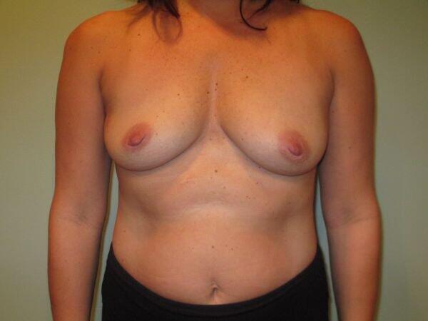 Breast Augmentation Before & After Image