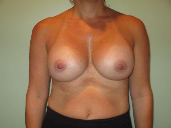 Breast Augmentation Before & After Image