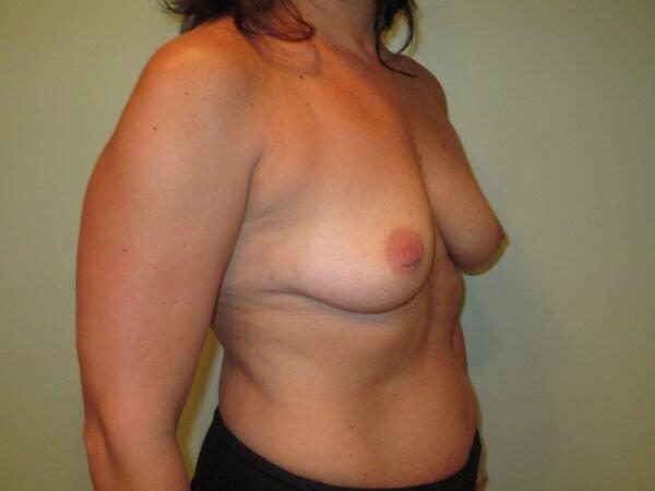 Breast Augmentation Before & After Image