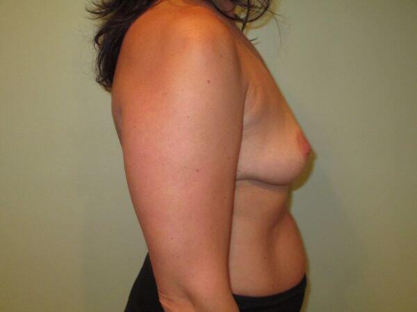 Breast Augmentation Before & After Image