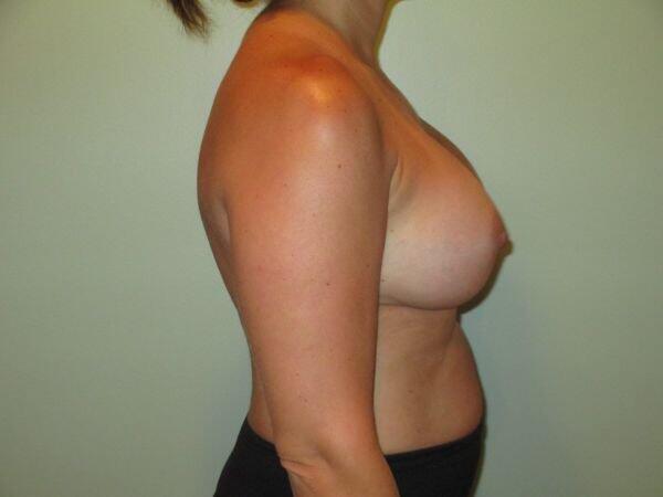 Breast Augmentation Before & After Image