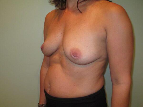 Breast Augmentation Before & After Image