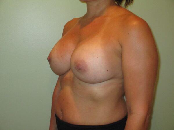 Breast Augmentation Before & After Image