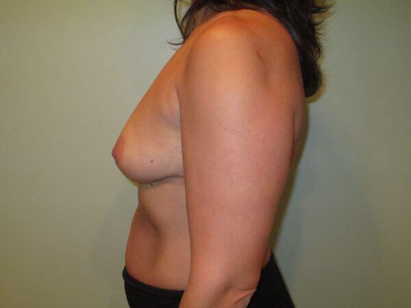 Breast Augmentation Before & After Image