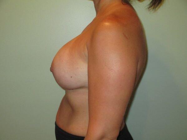 Breast Augmentation Before & After Image