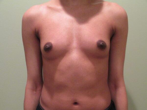 Breast Augmentation Before & After Image