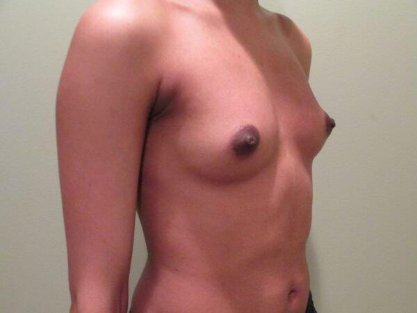 Breast Augmentation Before & After Image