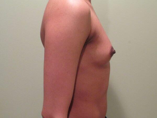 Breast Augmentation Before & After Image