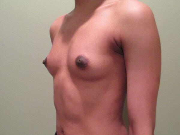 Breast Augmentation Before & After Image