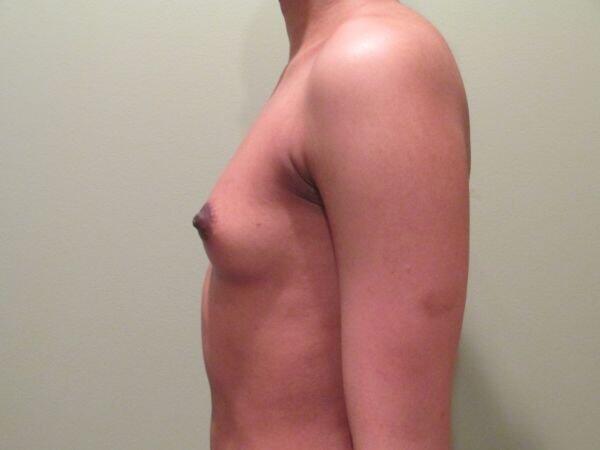 Breast Augmentation Before & After Image