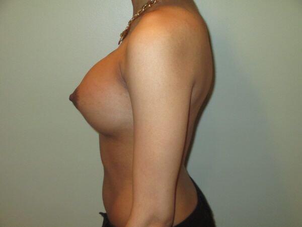 Breast Augmentation Before & After Image