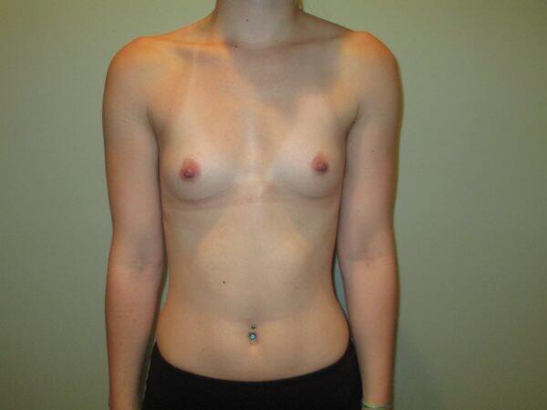 Breast Augmentation Before & After Image