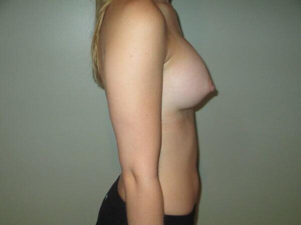 Breast Augmentation Before & After Image