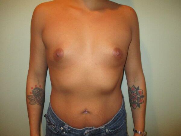 Breast Augmentation Before & After Image