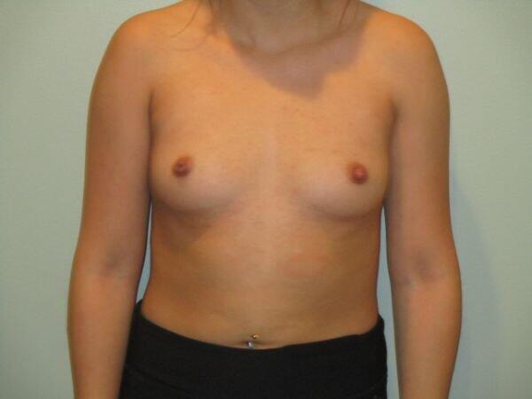 Breast Augmentation Before & After Image