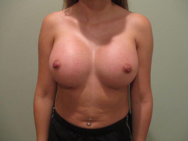 Breast Augmentation Before & After Image