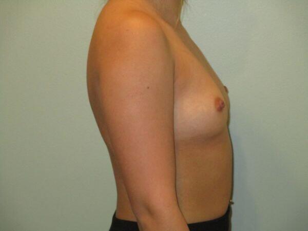 Breast Augmentation Before & After Image