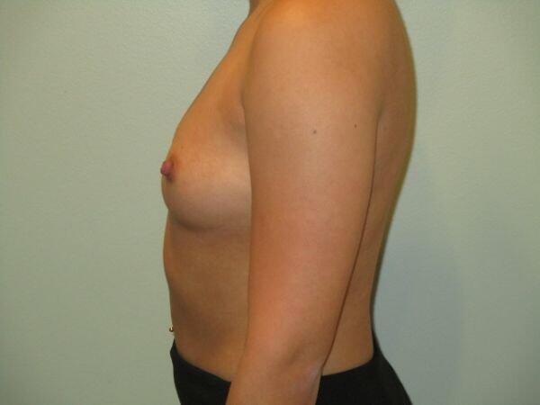 Breast Augmentation Before & After Image