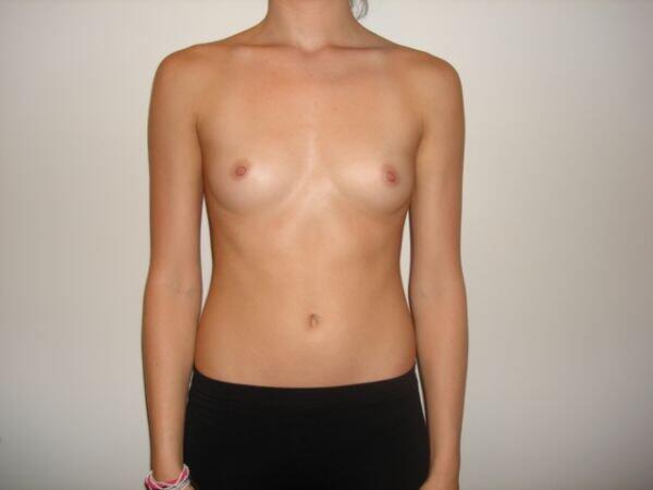 Breast Augmentation Before & After Image