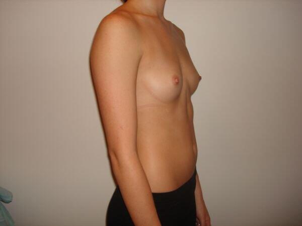 Breast Augmentation Before & After Image