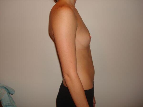 Breast Augmentation Before & After Image