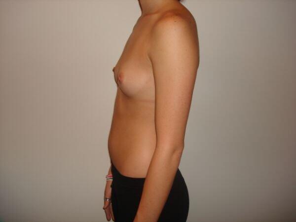 Breast Augmentation Before & After Image