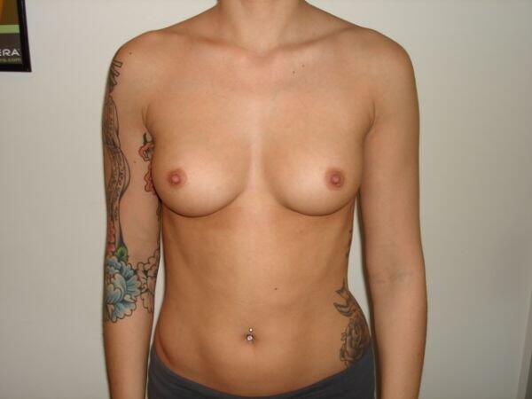 Breast Augmentation Before & After Image