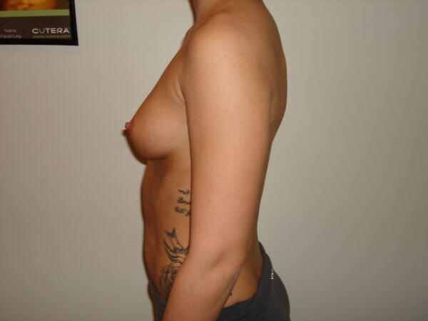 Breast Augmentation Before & After Image