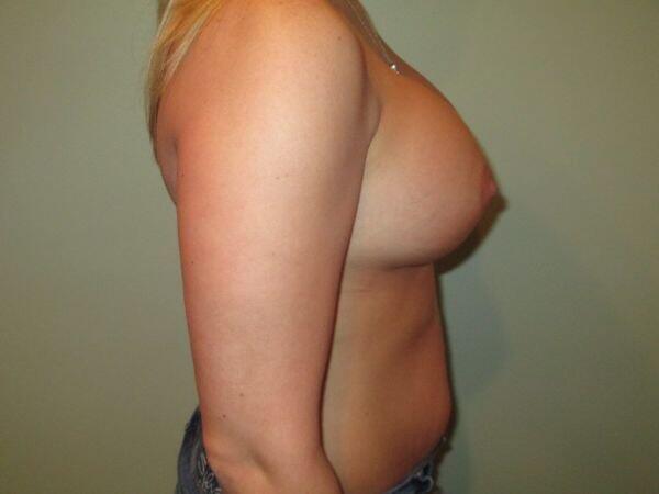 Breast Augmentation Before & After Image