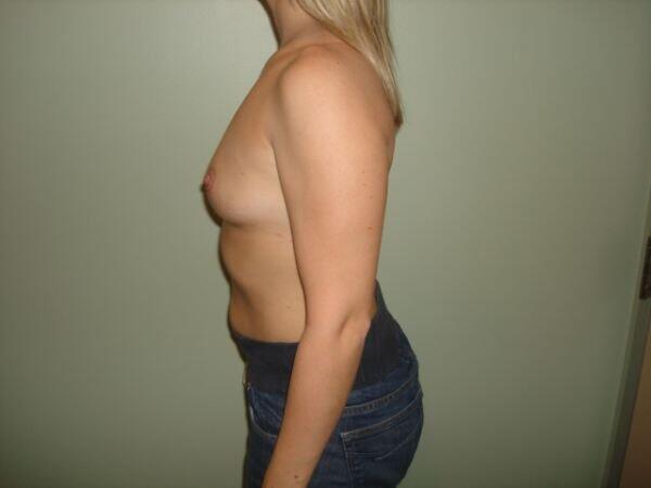 Breast Augmentation Before & After Image