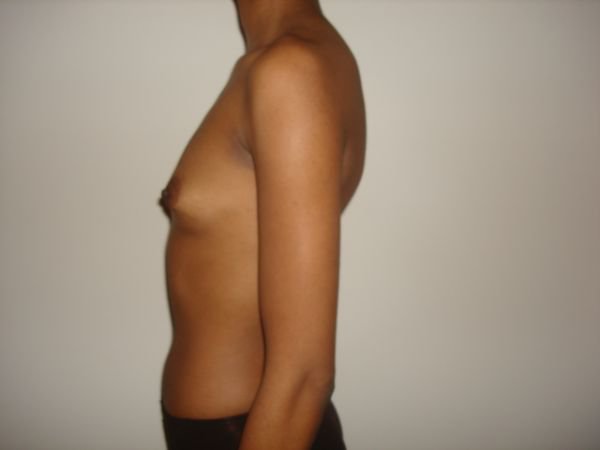 Breast Augmentation Before & After Image