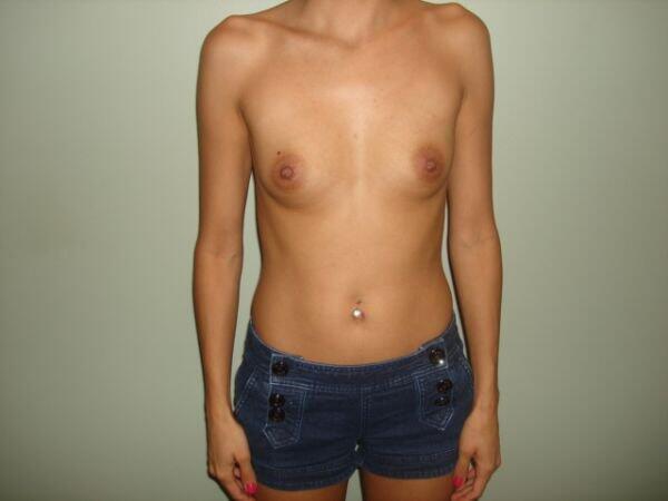 Breast Augmentation Before & After Image