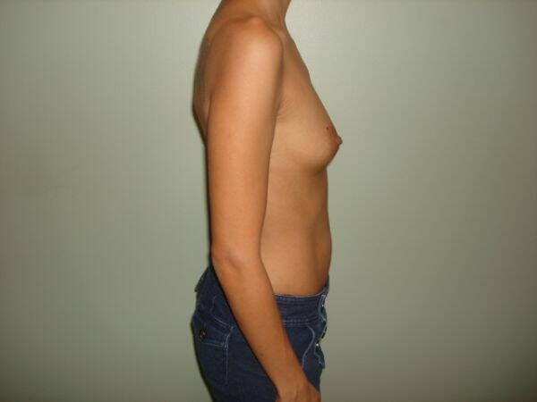 Breast Augmentation Before & After Image