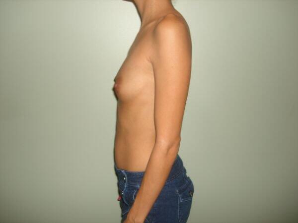 Breast Augmentation Before & After Image